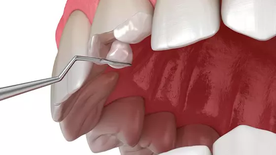 imagem 3D de dente sendo reconstruído 